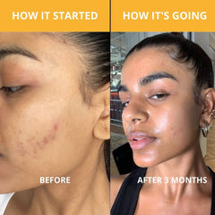 ARHGOAT Turmeric Kojic Acid Soap - Before & After Results