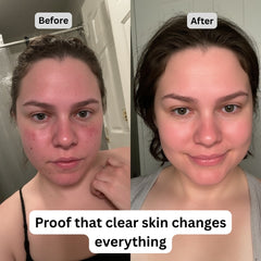 ARHGOAT Turmeric Kojic Acid Soap - Before & After Results